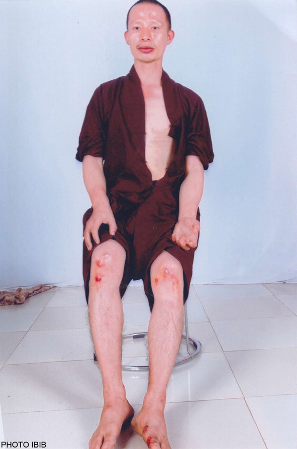 Thich Quang Thanh after his beating by police